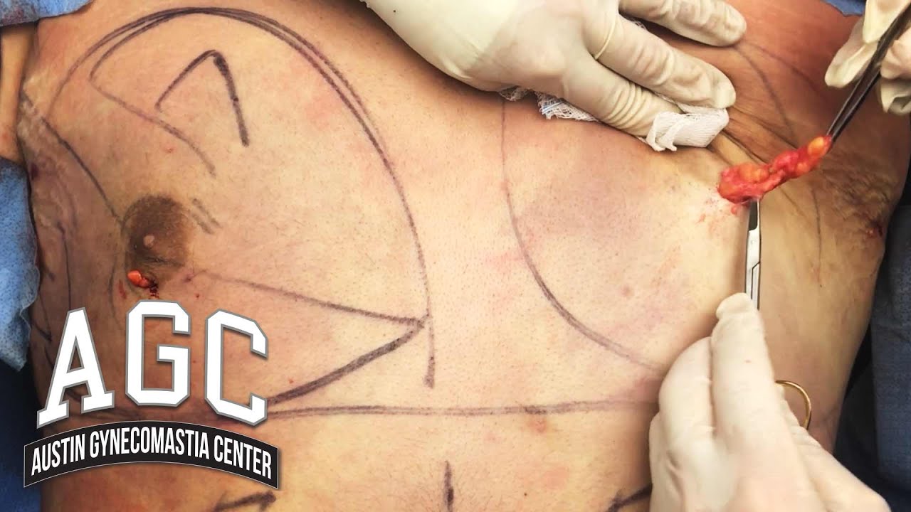 AGC Gynecomastia surgery video