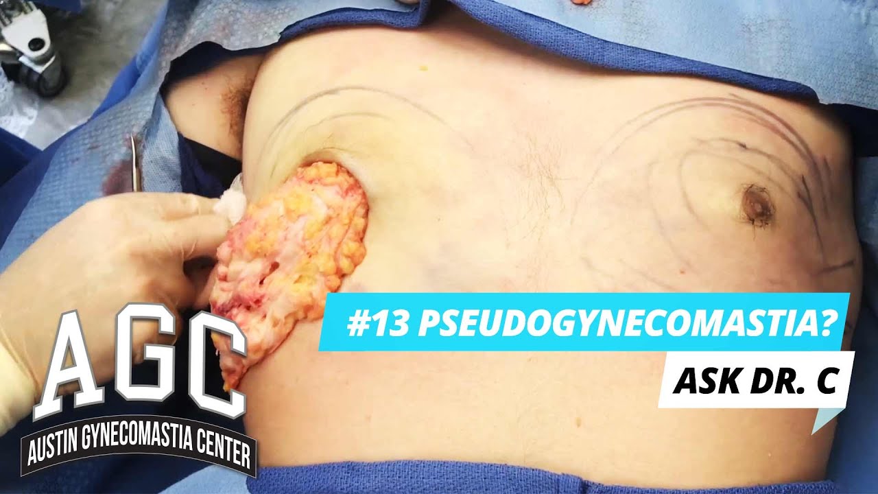 Pseudogynecomastia video