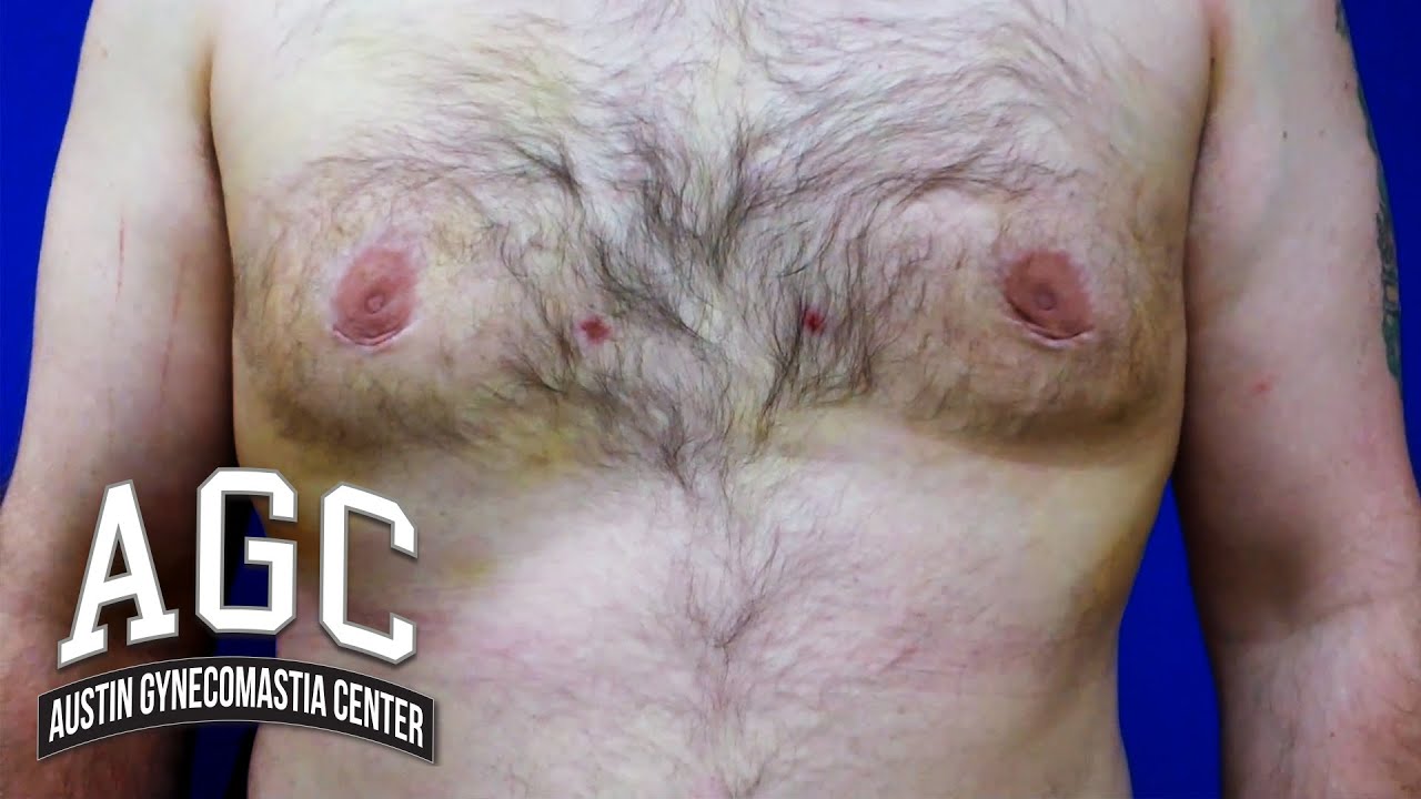 7 days after Gynecomastia surgery video