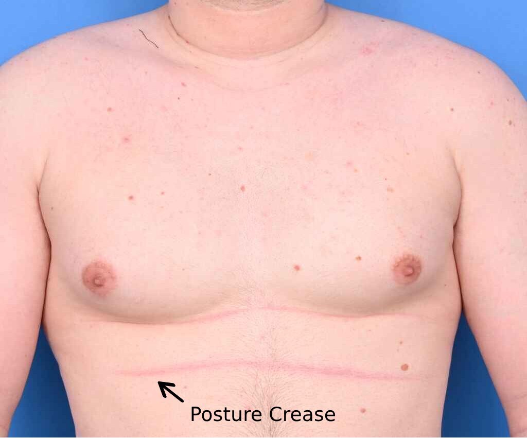 What You Need to Know About Gynecomastia and Good Posture