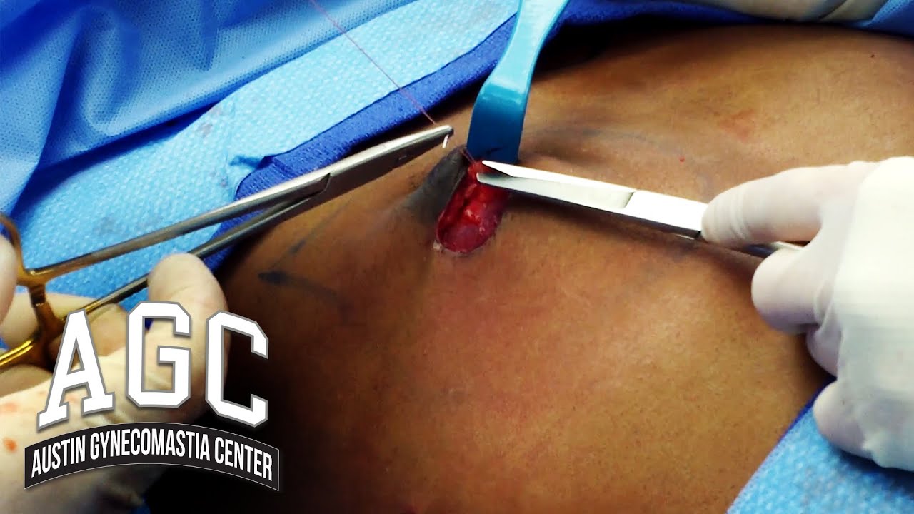 Quitting sutures or stitches video