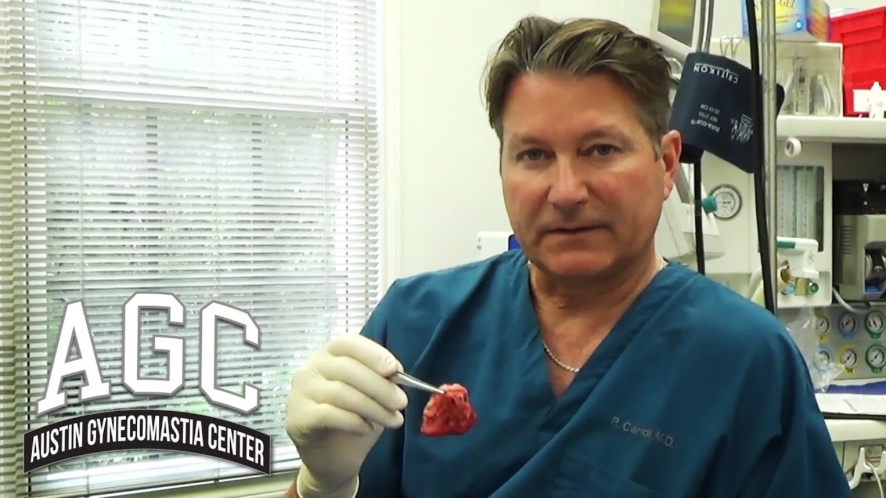 Why it's important to hold the gynecomastia gland video