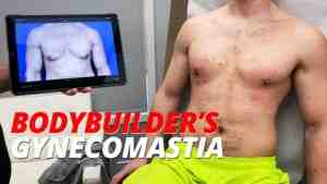 bodybuilder's gynecomastia treated at the Austin Gynecomastia Center
