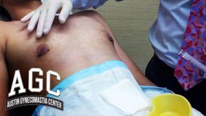 Gynecomastia Seroma Excess Fluid After Surgery
