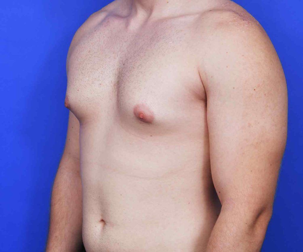 Male chest with pointy pectorals caused by gynecomastia