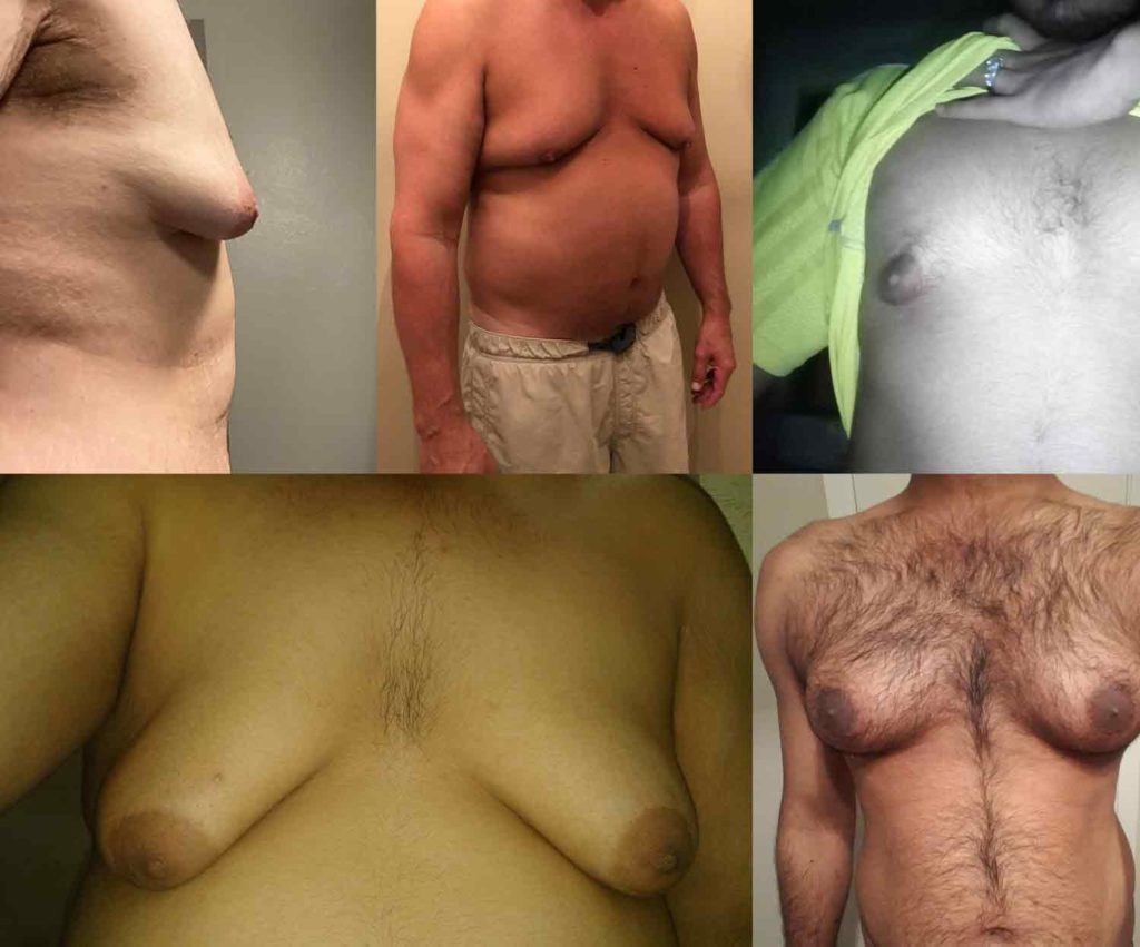 Collage of five men showing different gynecomastia chest shapes