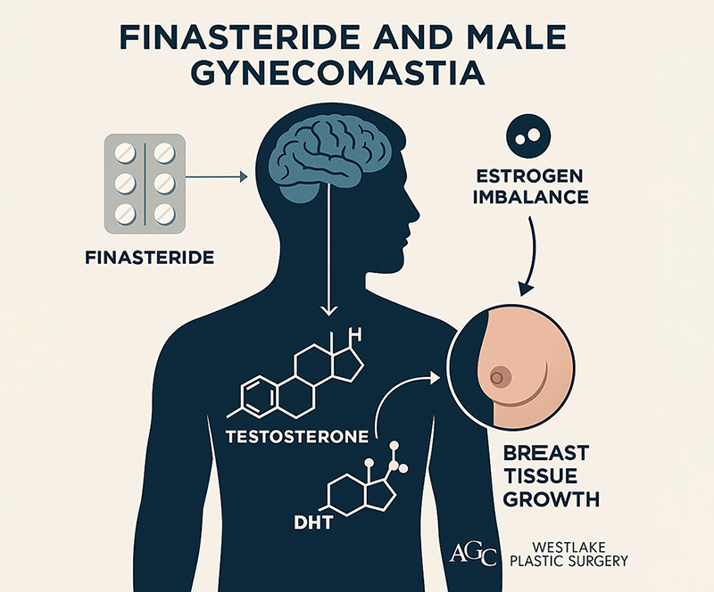 Finasteride and Gynecomastia: What Every Man Needs to Know