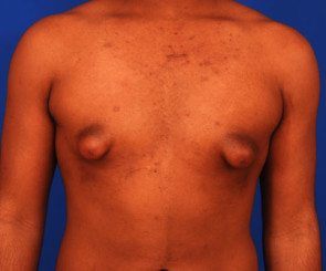 Male Tubular Breast condition