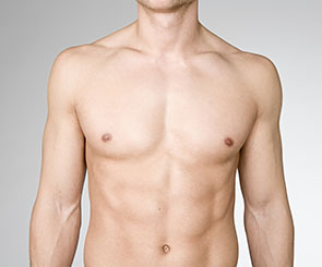 Gynecomastia Complications