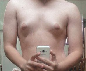 Male gynecomastia candidate