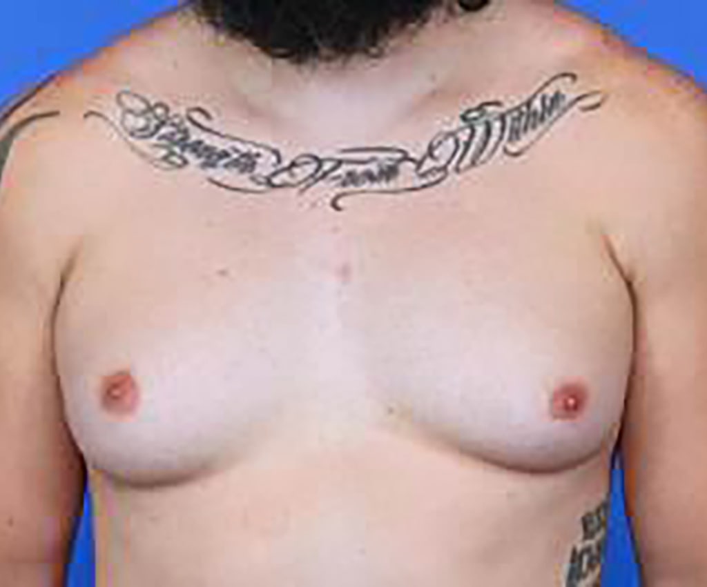 Is Gynecomastia Treatable?