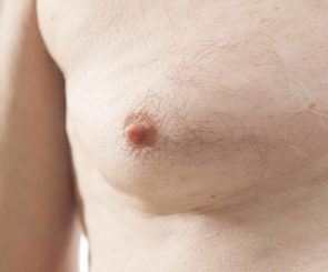 Closeup on enlarged male breast
