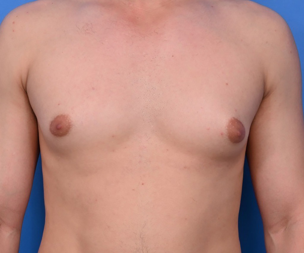 Patient chest showing puffy nipples before treatment