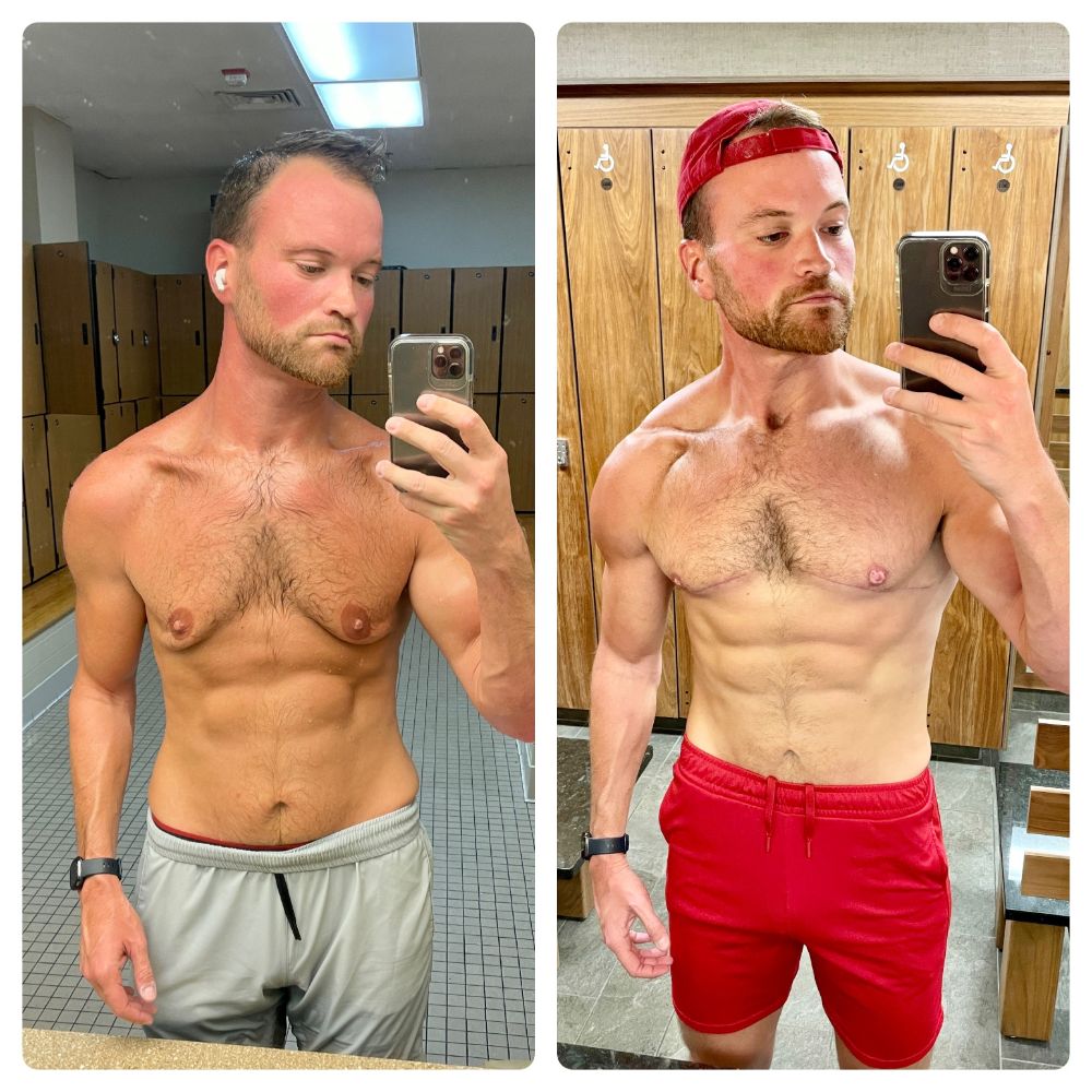 Chest before and after gynecomastia skin removal surgery