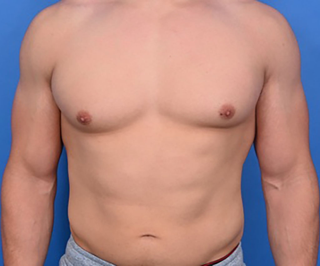When Is Gynecomastia Bad Enough to Get Surgery?