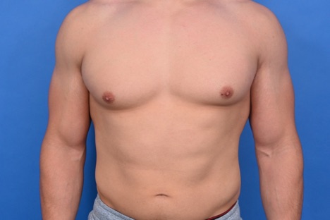 Male chest with untreated gynecomastia