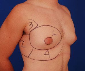 Pre surgery examination on gynecomastia patient