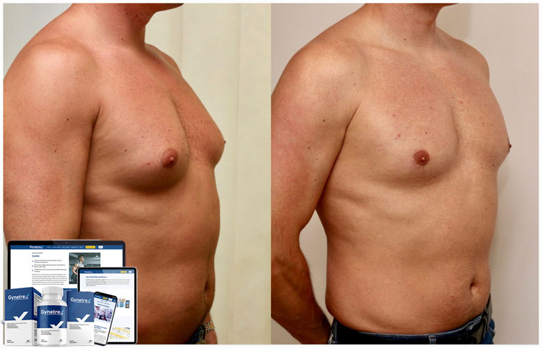 Gynetrex Before And After Pictures