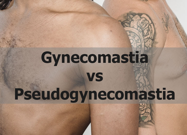 Gynecomastia vs Pseudogynecomastia