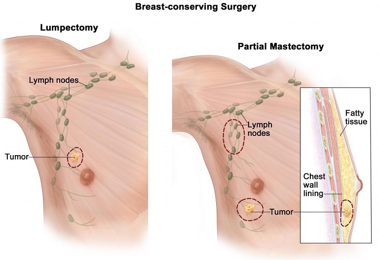 Treatment For Male Breast Cancer